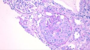 crescentic glomerulonephritis